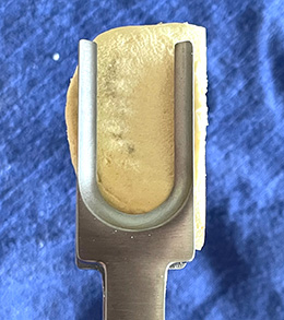 Rosenstein Forked UKA Tibial Fragment Grasper