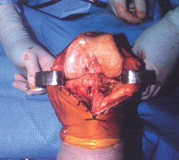 "S" Total Knee Retractors