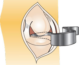"S" Total Knee Retractor