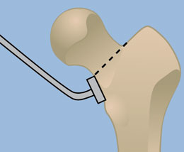 Sanders Femoral Neck Cutting Blocks