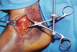 Medial Malleolar/Bone Fragment Clamps