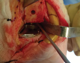 Scott Uni & Total Knee Cement Removing Curette
