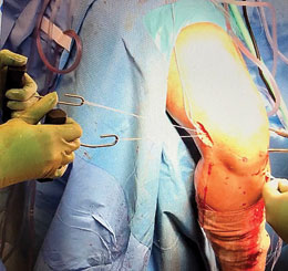 Seymour ACL Graft Advancer