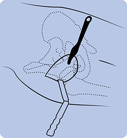 Sierra OrthoLucent™ Pelvic Osteotomy Retractor
