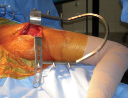 Charnley/Sorrells Low-Profile Hip Arthroplasty Retractor System
