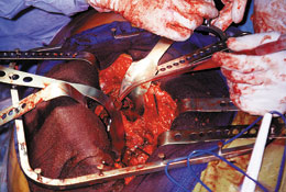 Hip Surgery Retractor System