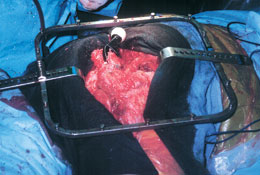 Hip Surgery Retractor System
