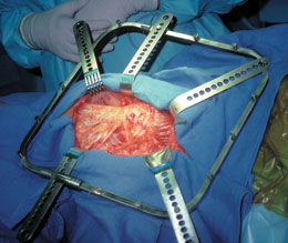 Hip Surgery Retractor System