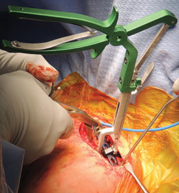 Stoll Bone Plate Clamp