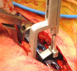 Stoll Bone Plate Clamp