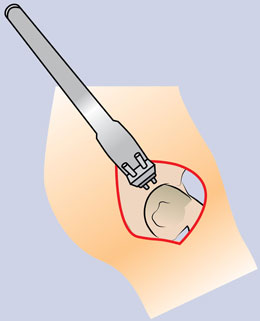 Superior Retractor