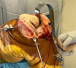 Lonner Swan Lateral Knee Retractor