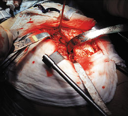 APC Hip Retractor Series