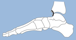 Anderson Talar Neck Osteotome