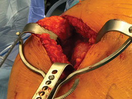 Self-Retaining Tension Retractor