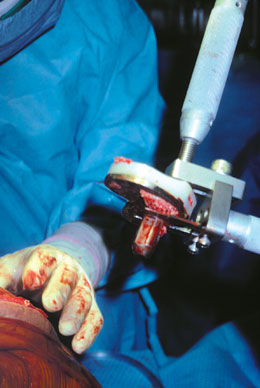 Tibial Component Extractor