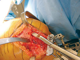 Universal Calibrated Tibia/Patella Clamp