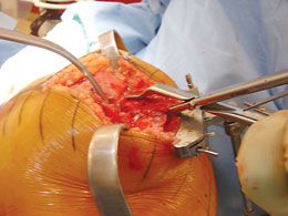 Universal Calibrated Tibia/Patella Clamp