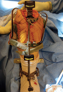 Tibia AccuAngle & Tibia Alignment AccuAngle