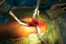 Unger Anterior Total Hip Instruments