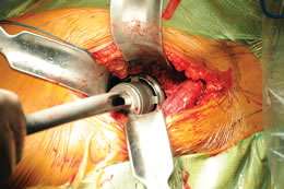 Unger Anterior Total Hip Instruments