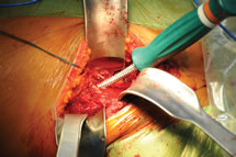 Unger Anterior Total Hip Instruments