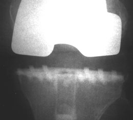 Woolley Tibia Punch