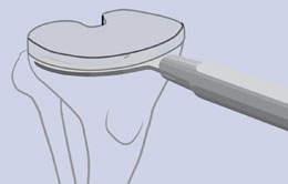 Whang Tibial Osteotome