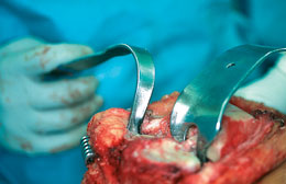 Collateral Ligament Retractor