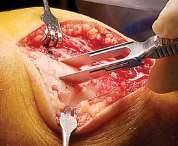 Wilson Double Scalpel Handle
