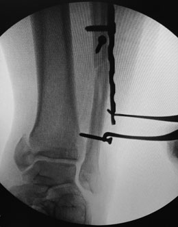 Wixted Fracture Distractor