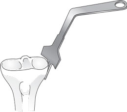 Wubben Lateral Fat Pad Retractor for TKR