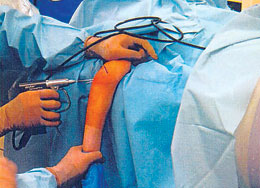 Distal Humerus Fracture Board