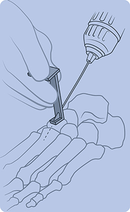 Zell Fixed Angle Wire Guide