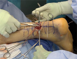 Percutaneus Achilles Repair Forceps