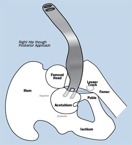 Curved Cobra Retractors