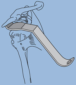 Kirschenbaum Acromioplasty Retractor