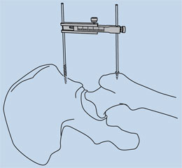 Leg Length Caliper