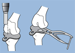Sorrells Tibia Protector Plates