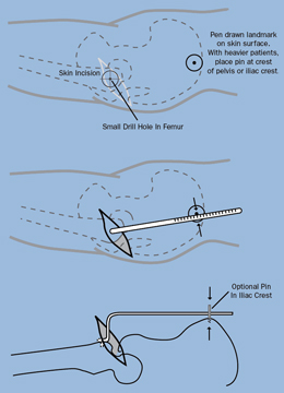 Wixson Leg Length Gauge