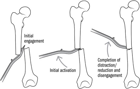 AK Fracture Reducer