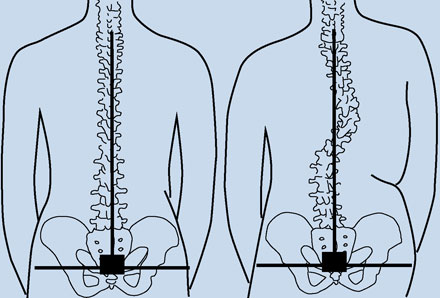 Bernard Spinal Alignment Block
