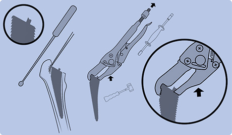 Broach Extraction OrthoVise