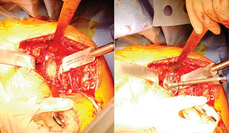 Burkhead Glenoid Retractor