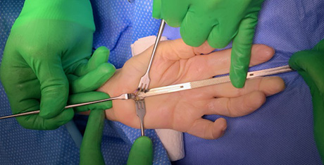 Carpal Tunnel Release Guide and Blade Set
