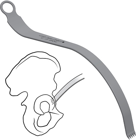 Chandran Anterior Retractor for THR