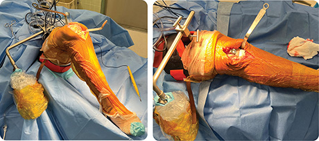 Chandran Thigh Lift Positioner