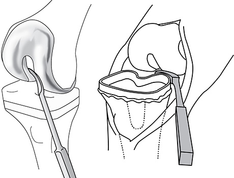 Curved Cement Osteotome