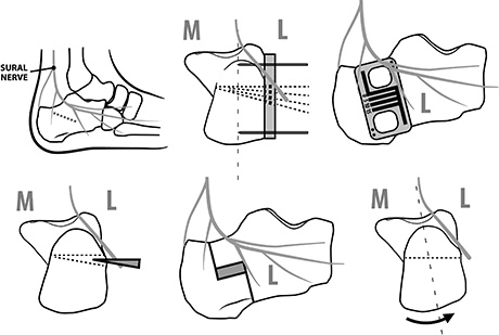 DeOrio Calcaneal Z-Osteotomy Guide