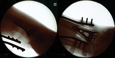 DodsonX-RayImage